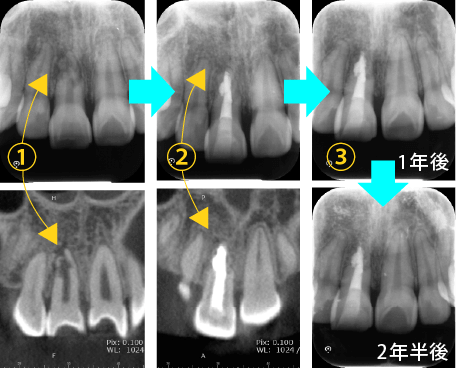根管治療｜かい歯科クリニック・大阪市谷町九丁目駅・上本町の歯医者