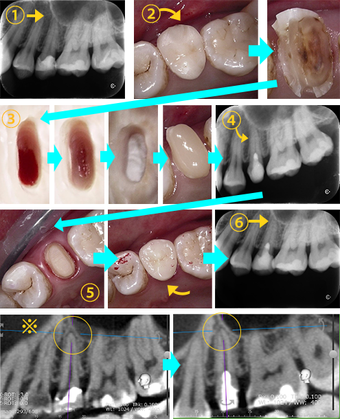 歯頚部断髄　症例⑩