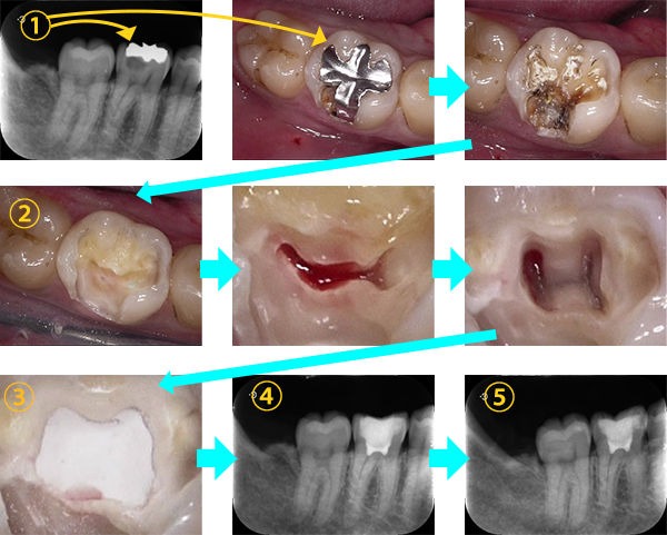 歯頚部断髄　症例⑪